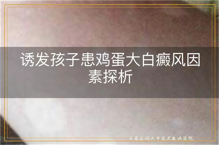 诱发孩子患鸡蛋大白癜风因素探析