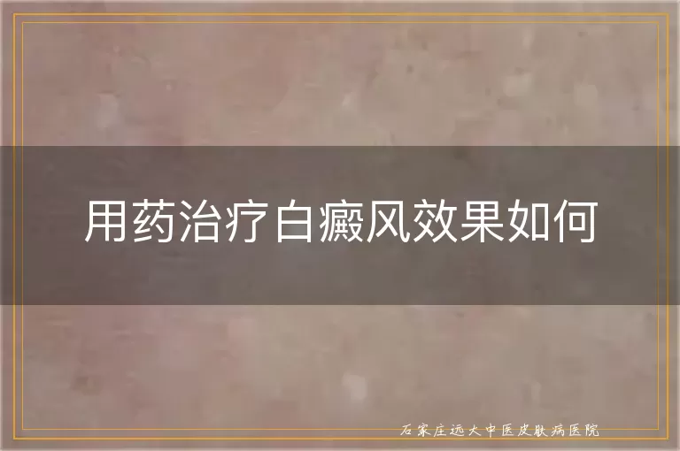 用药治疗白癜风效果如何