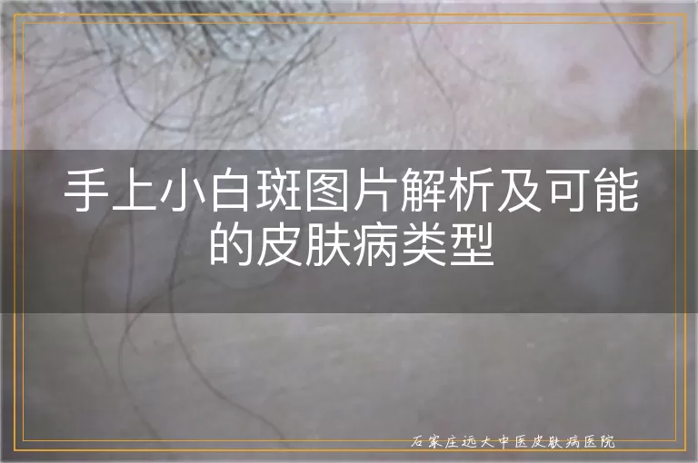 手上小白斑图片解析及可能的皮肤病类型
