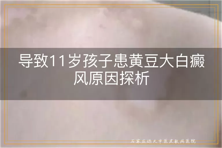 导致11岁孩子患黄豆大白癜风原因探析