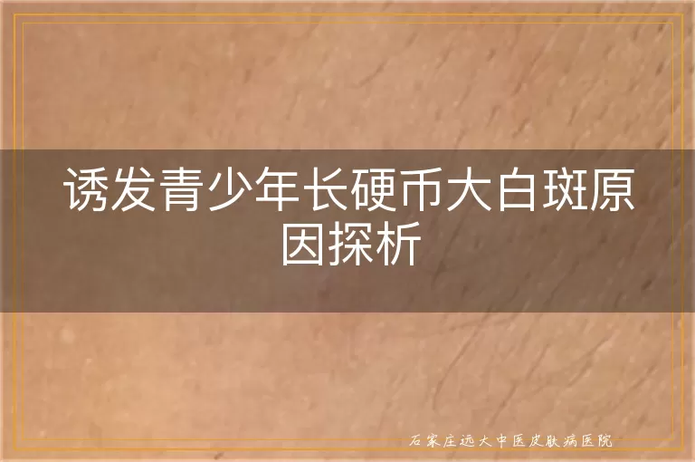 诱发青少年长硬币大白斑原因探析
