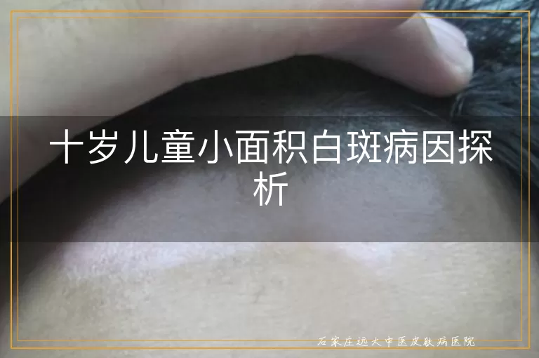十岁儿童小面积白斑病因探析