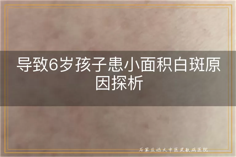 导致6岁孩子患小面积白斑原因探析