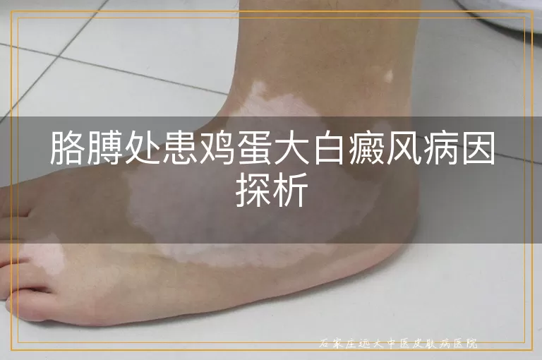 胳膊处患鸡蛋大白癜风病因探析