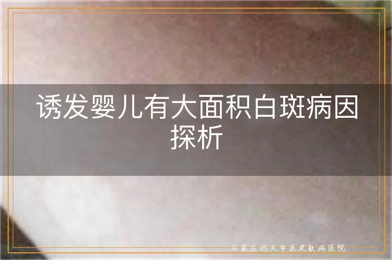 诱发婴儿有大面积白斑病因探析