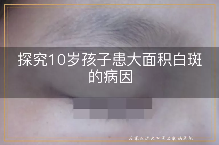 探究10岁孩子患大面积白斑的病因
