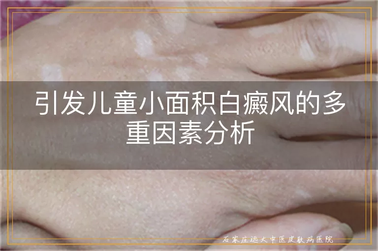 引发儿童小面积白癜风的多重因素分析