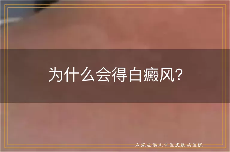 为什么会得白癜风？