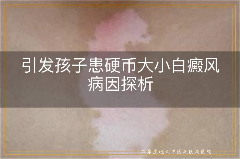 引发孩子患硬币大小白癜风病因探析