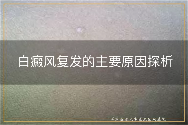 白癜风复发的主要原因探析