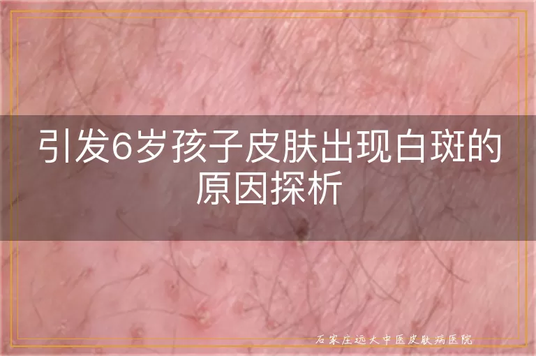 引发6岁孩子皮肤出现白斑的原因探析