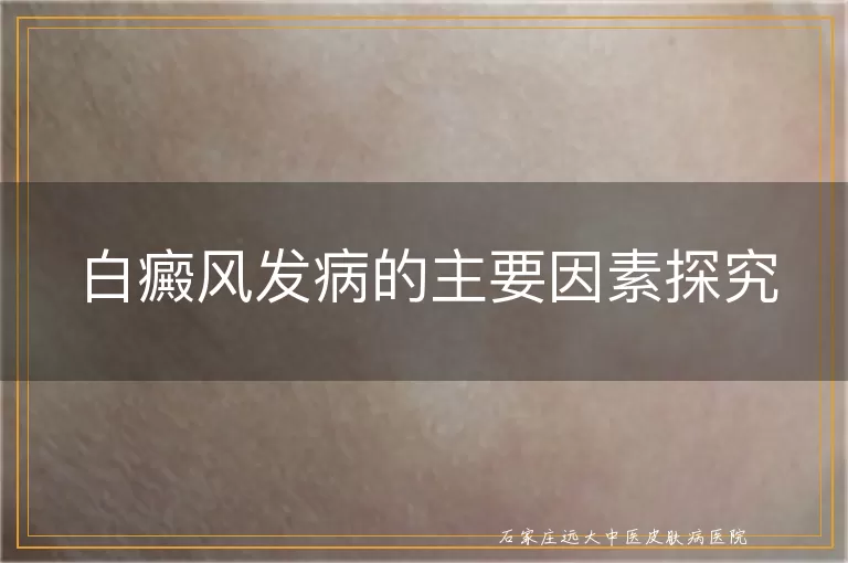 白癜风发病的主要因素探究