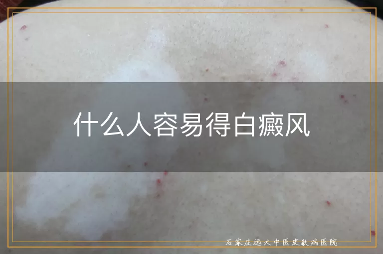 什么人容易得白癜风
