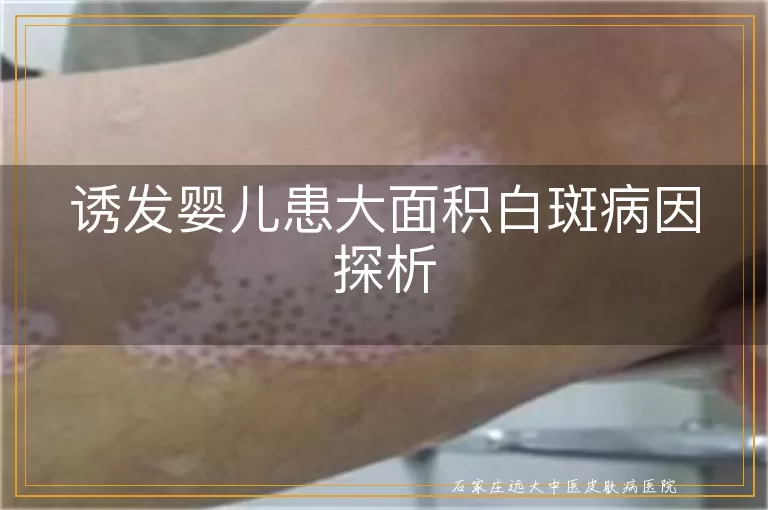 诱发婴儿患大面积白斑病因探析