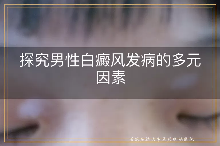探究男性白癜风发病的多元因素