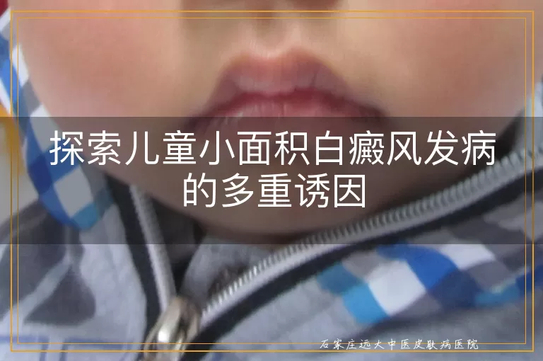 探索儿童小面积白癜风发病的多重诱因