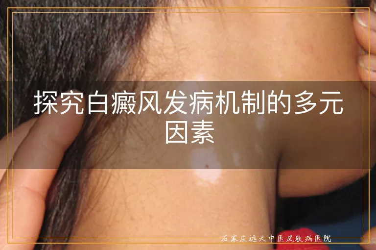 探究白癜风发病机制的多元因素