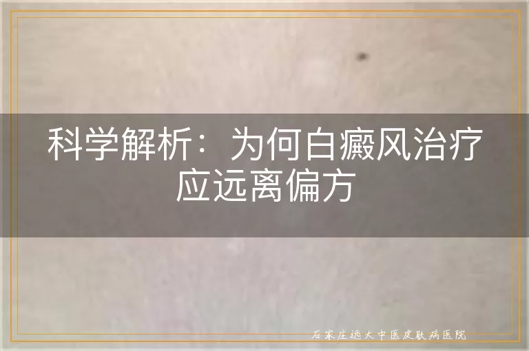 科学解析：为何白癜风治疗应远离偏方