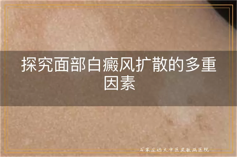 探究面部白癜风扩散的多重因素