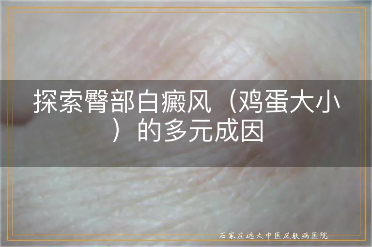 探索臀部白癜风（鸡蛋大小）的多元成因