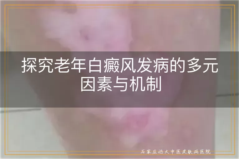 探究老年白癜风发病的多元因素与机制