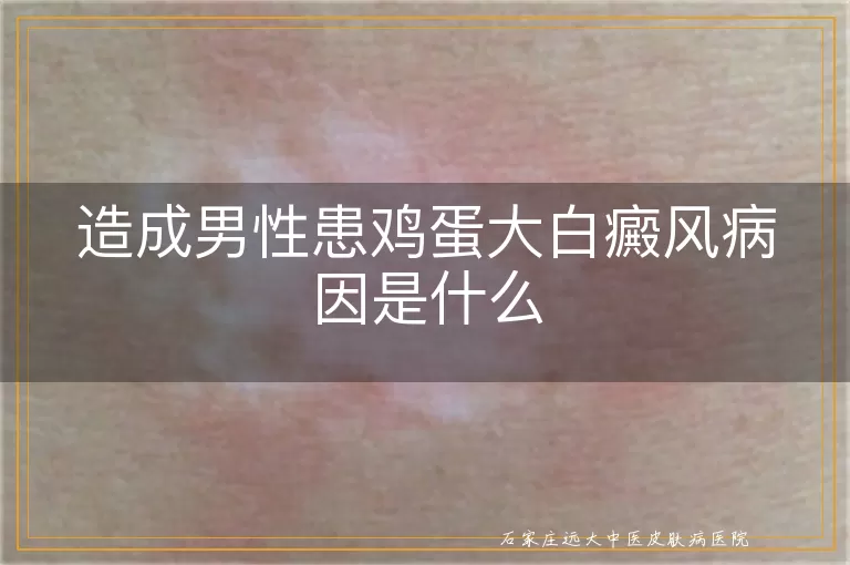 造成男性患鸡蛋大白癜风病因是什么