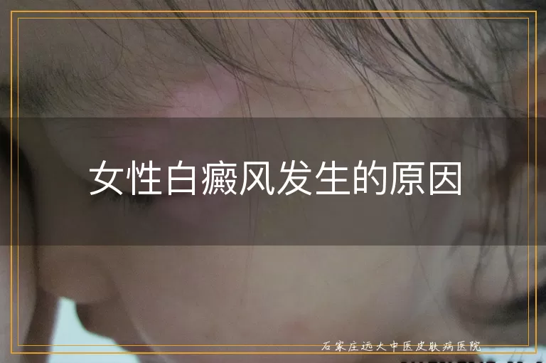 女性白癜风发生的原因