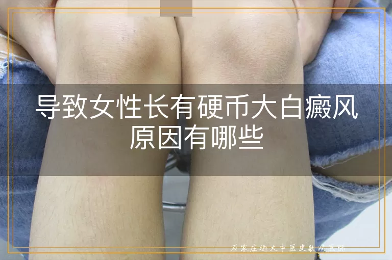 导致女性长有硬币大白癜风原因有哪些