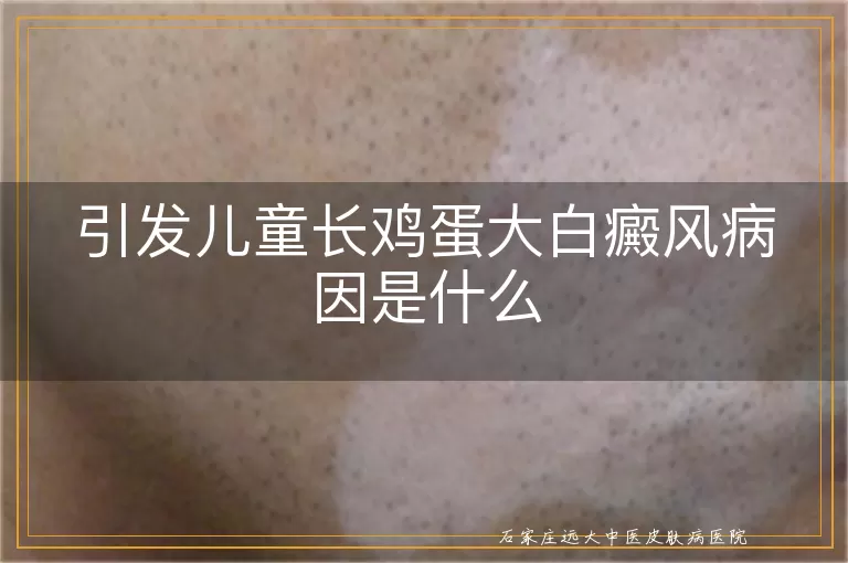 引发儿童长鸡蛋大白癜风病因是什么