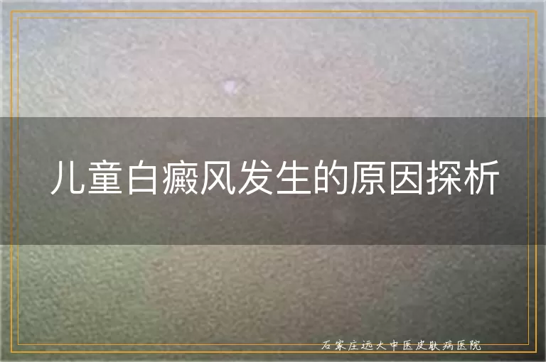 儿童白癜风发生的原因探析