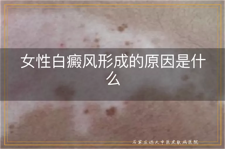 女性白癜风形成的原因是什么