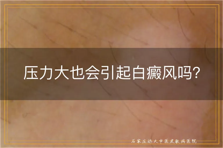 压力大也会引起白癜风吗？