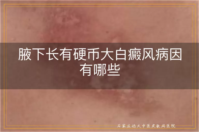 腋下长有硬币大白癜风病因有哪些