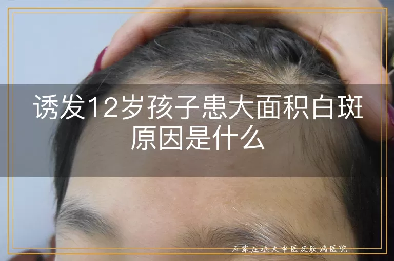 诱发12岁孩子患大面积白斑原因是什么