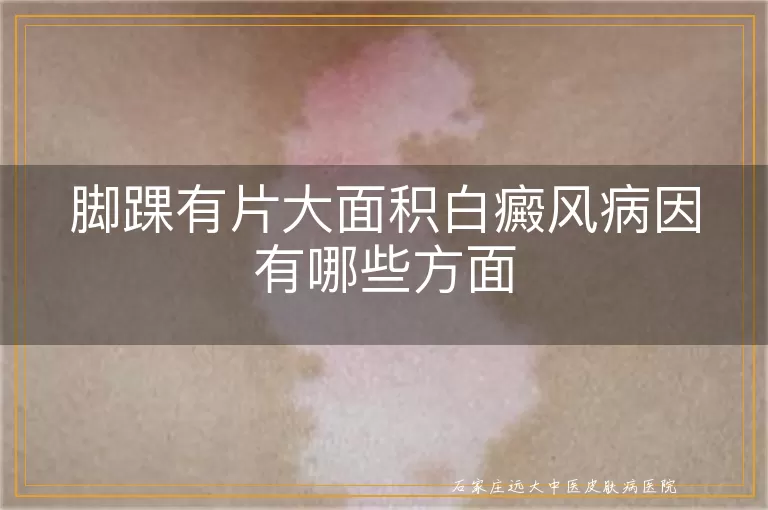 脚踝有片大面积白癜风病因有哪些方面