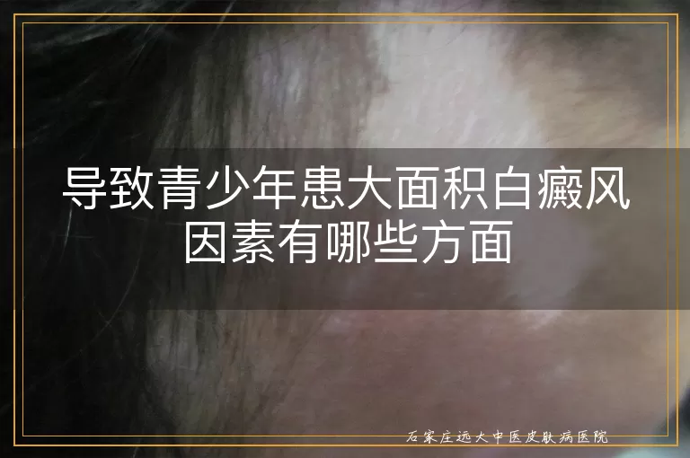 导致青少年患大面积白癜风因素有哪些方面
