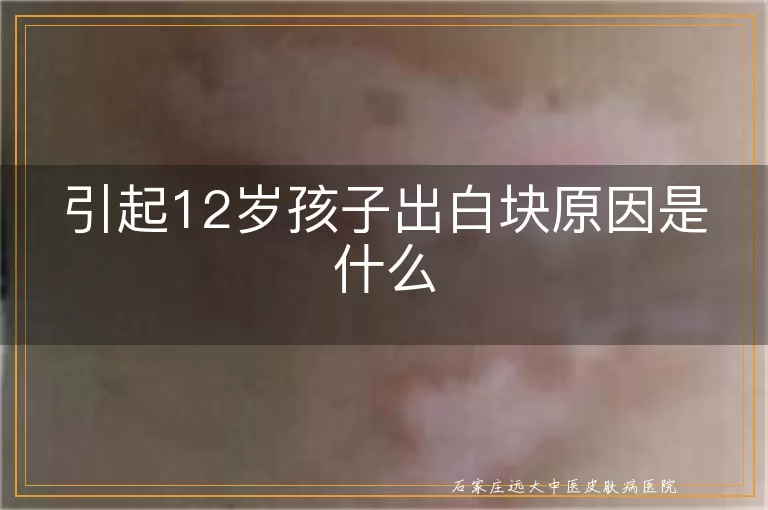 引起12岁孩子出白块原因是什么