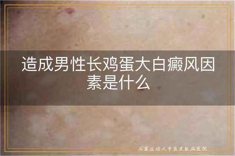 造成男性长鸡蛋大白癜风因素是什么