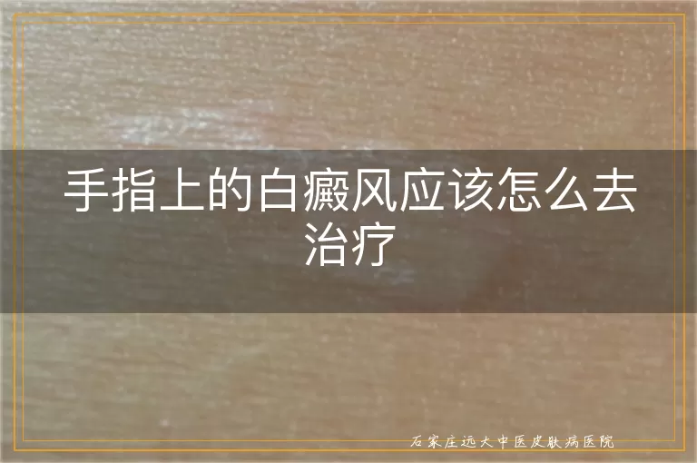手指上的白癜风应该怎么去治疗