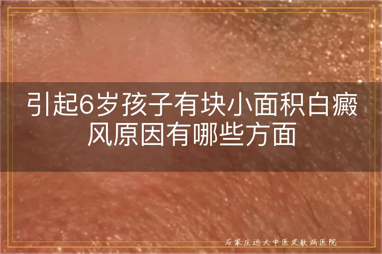 引起6岁孩子有块小面积白癜风原因有哪些方面