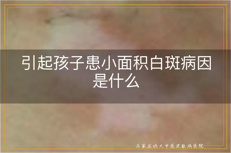 引起孩子患小面积白斑病因是什么