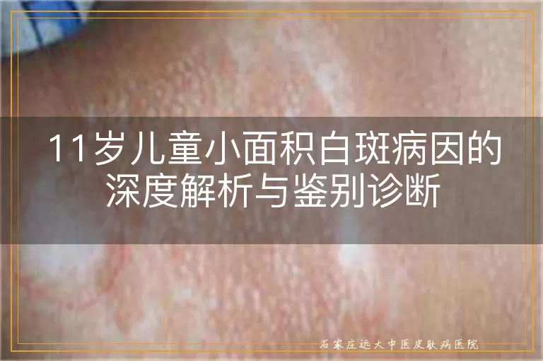 11岁儿童小面积白斑病因的深度解析与鉴别诊断
