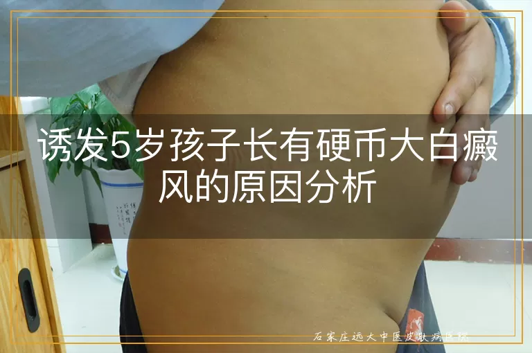 诱发5岁孩子长有硬币大白癜风的原因分析