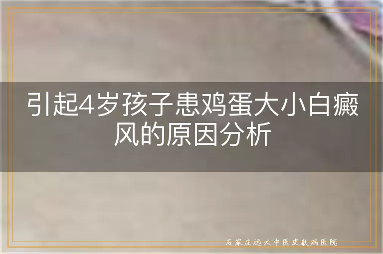 引起4岁孩子患鸡蛋大小白癜风的原因分析