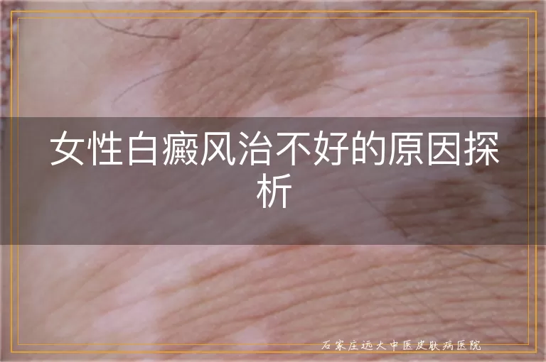 女性白癜风治不好的原因探析
