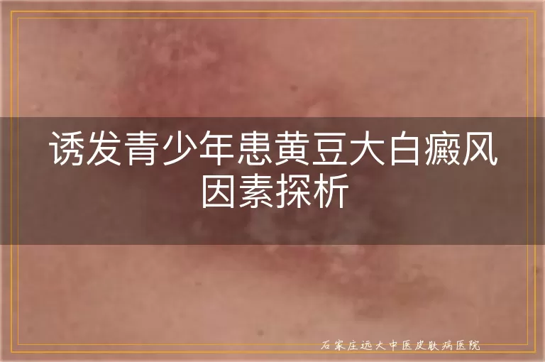 诱发青少年患黄豆大白癜风因素探析
