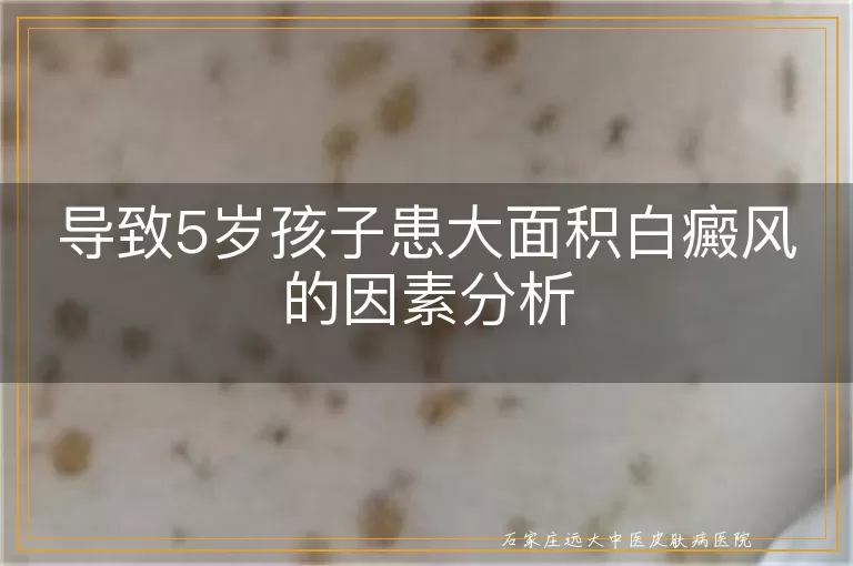 导致5岁孩子患大面积白癜风的因素分析