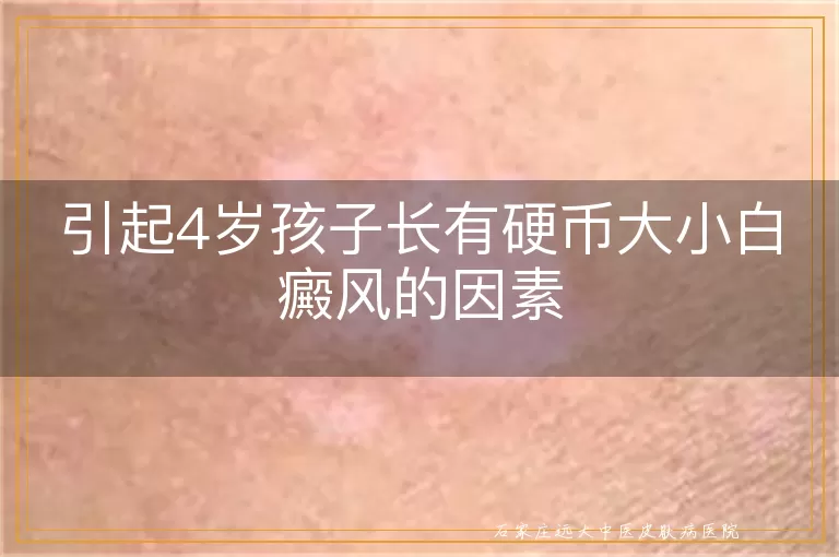 引起4岁孩子长有硬币大小白癜风的因素