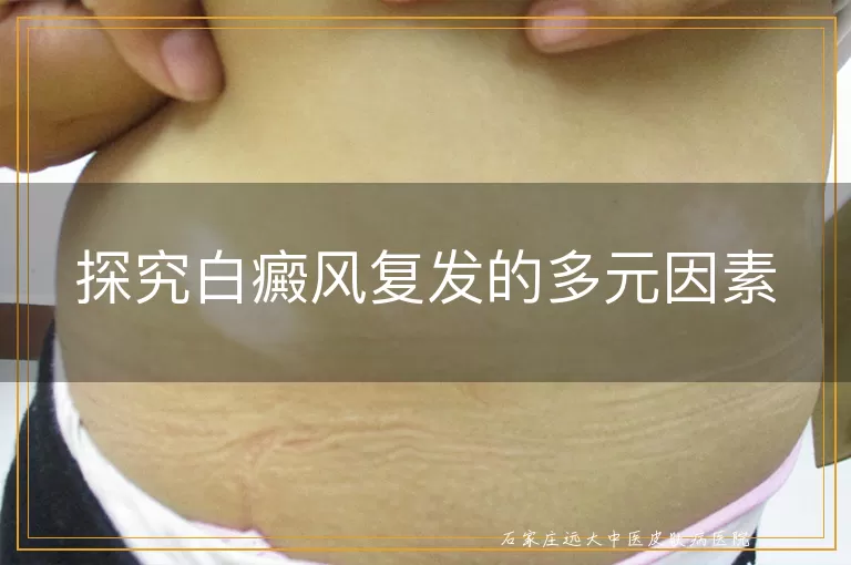 探究白癜风复发的多元因素