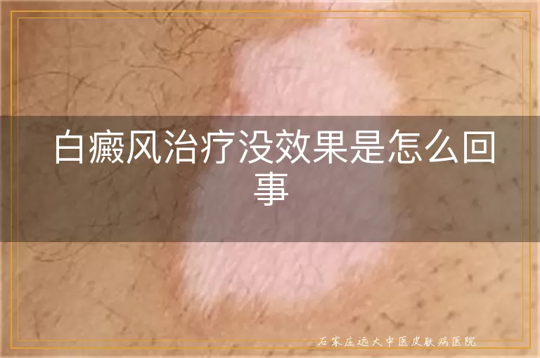 白癜风治疗没效果是怎么回事